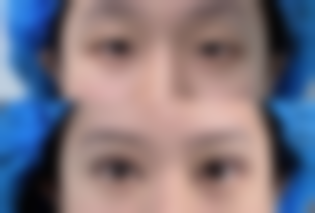  韩国Bustium整形外科车秉勋医生技术怎么样