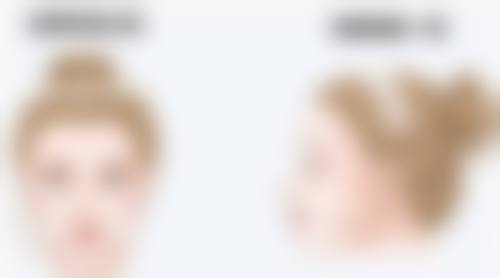 崔宇植 Noselips 整形外科（原 MVP 整形外科）治疗反馈与口碑评价。