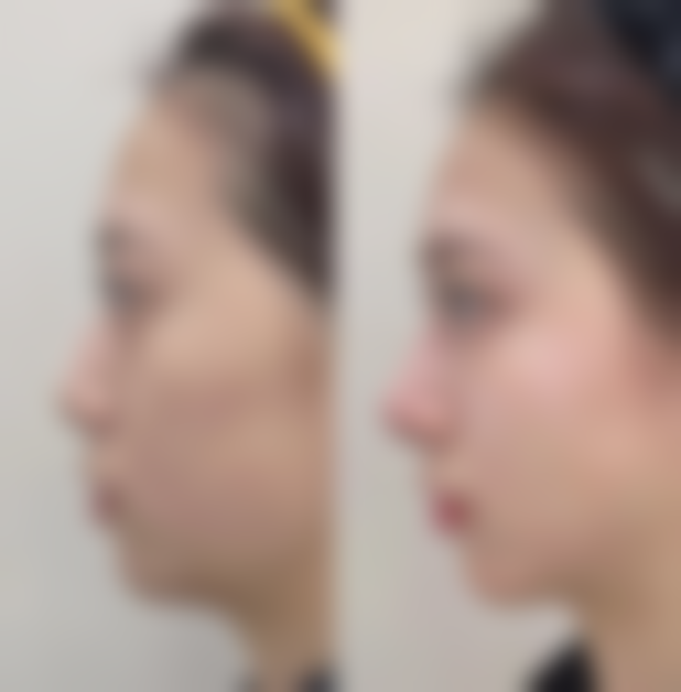 Herb整形外科徐光锡医生技术怎么样