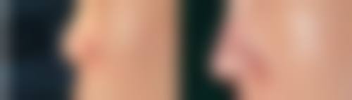 呼和浩特雅诗顿整形医院口碑评价与项目分享：