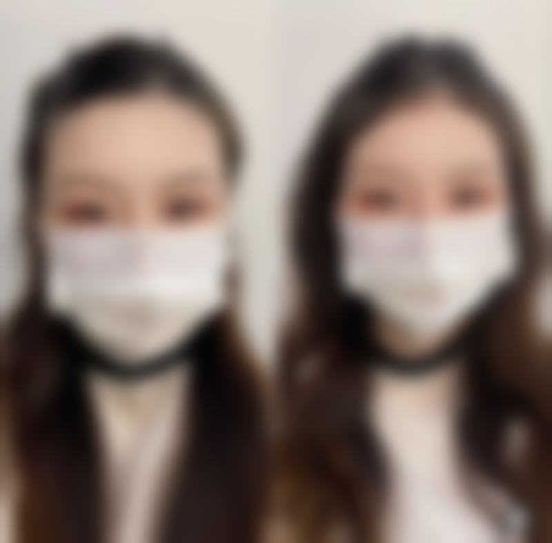 临沂东方美莱坞整形美容治疗反馈与口碑评价。