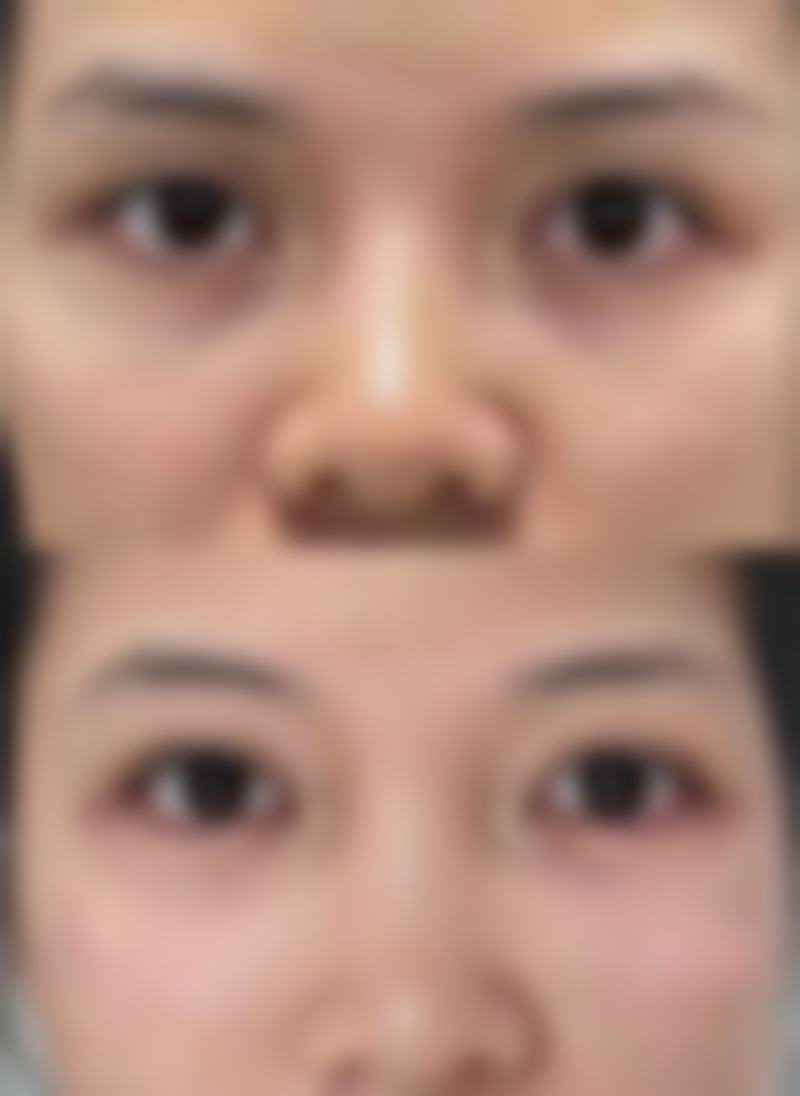 泉州阳光纯韩整形治疗反馈与口碑评价