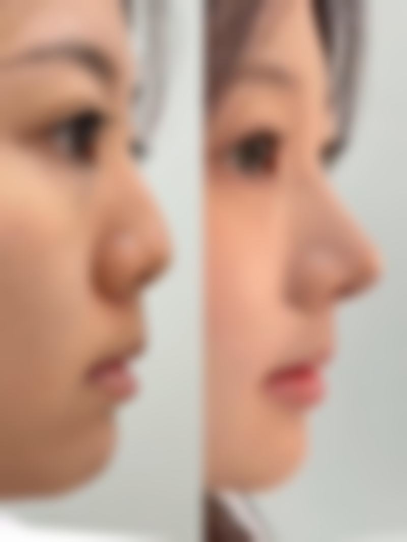 广州美咖整形医院林丰医生技术怎么样