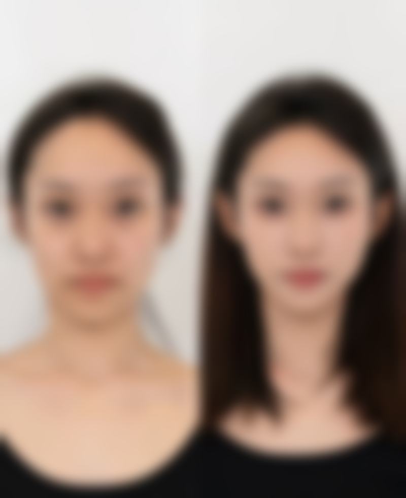 六安欣安整形医院治疗反馈与口碑评价。