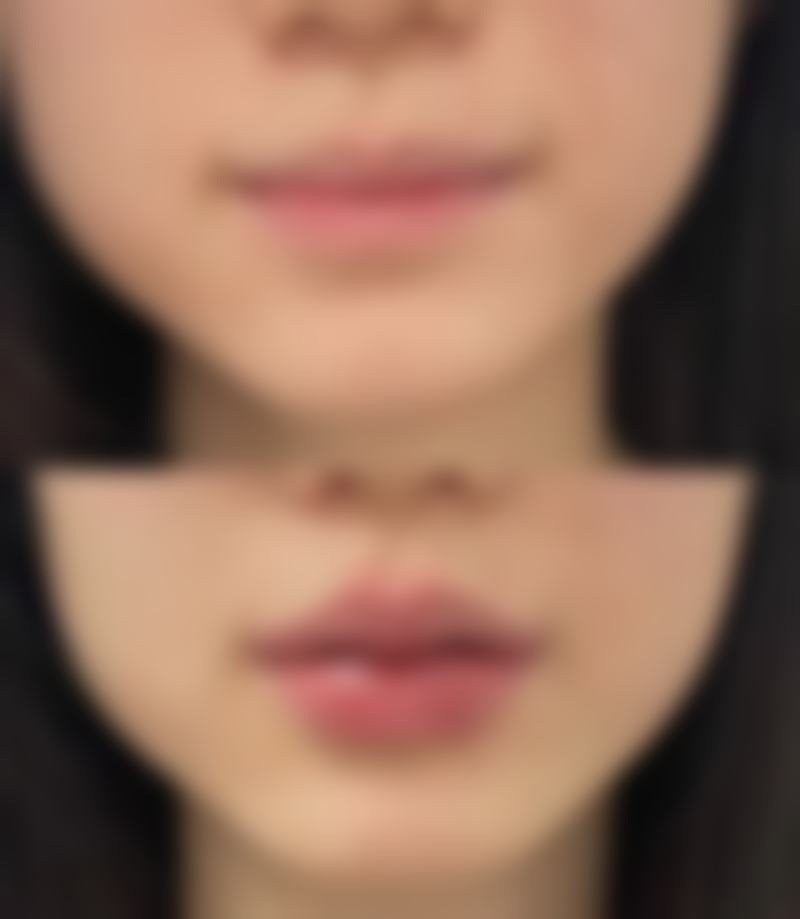 深圳妙颜(轻苇)医疗美容诊所治疗反馈与口碑评价。