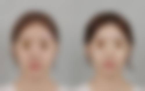 惠州华壹汇(美巢)医疗美容门诊部治疗反馈与口碑评价。